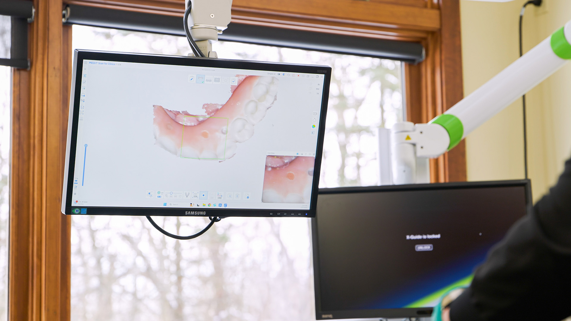 Implant Supported Dentures Portage Mi Dentists